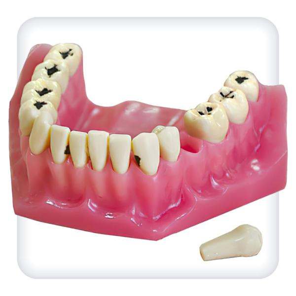 Model of the upper and lower jams with 32 model teeth for caries treatment