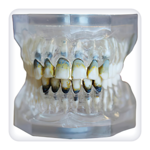 Model of the upper and lower jams with 28 model teeth for the periodontal disease treatment