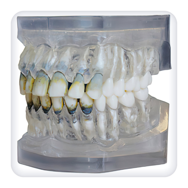 Model of the upper and lower jams with 28 model teeth for the periodontal disease treatment